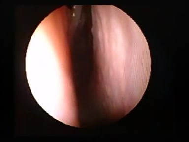 Endoskopische Darstellung normaler Nasenmuscheln 