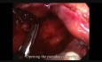 Laparoskopische Chirurgie für infizierte Pankreas-Pseudozyste