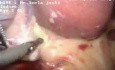 Sleeve-Gastrektomie mit Cholezystektomie und Hernioplastik mittels Mesh