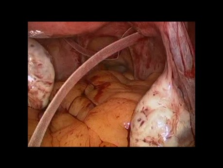 SELS: laparoskopische transabdominale Cerclage 