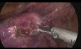 Totale laparoskopische Hysterektomie mit Lymphadenektomie