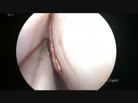 Pansinusitis + Septumplastik und Turbinoplastik