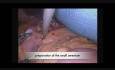 Gastrischer Bypass – Bariatrische Chirurgie – Der Fall des Patienten mit Situs inversus