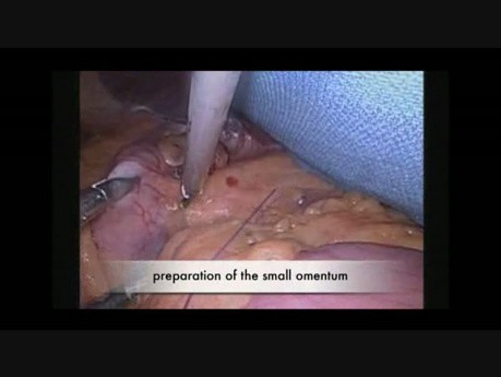 Gastrischer Bypass – Bariatrische Chirurgie – Der Fall des Patienten mit Situs inversus