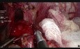 Kardiomyotomie nach Heller mit Dor Fundoplikatio - eine Behandlung von Achalasie