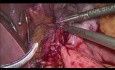 Von der laparoskopischen Magenplikatur bis zum Roux-en-Y-Magenbypass 