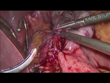 Von der laparoskopischen Magenplikatur bis zum Roux-en-Y-Magenbypass 