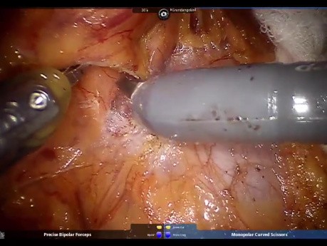 Roboterassistierte milzerhaltende Pankreaslinksresektion bei solid-pseudopapillärem Neoplasma