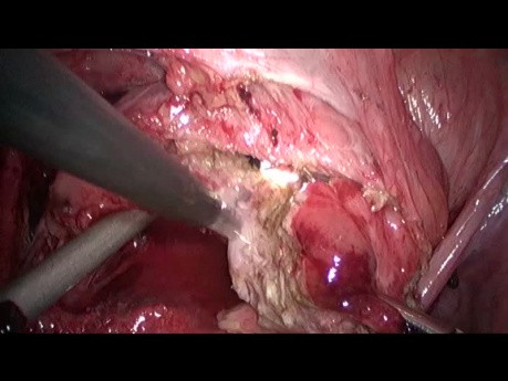 Laparoskopische Resektion der Blasenendometriose
