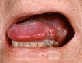 Plattenepithelkarzinom an der Zunge