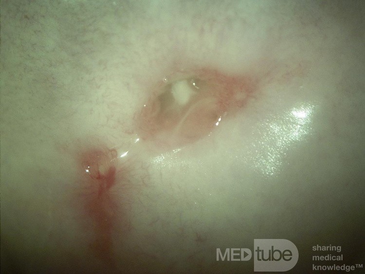Zervikale Endometriose