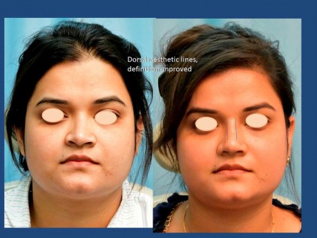 Finesse Rhinoplastik