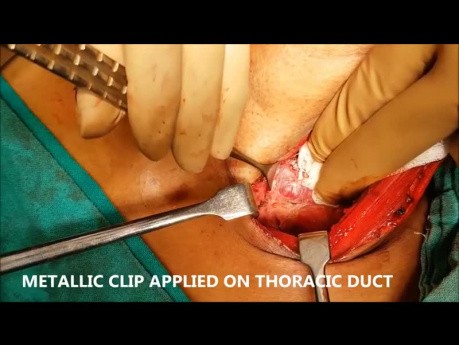  Chylusleckage im Hals vom Ductus thoracicus