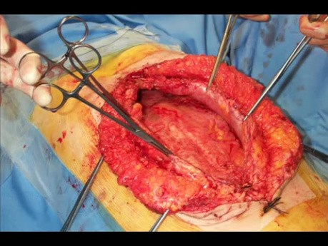 Laparotomie - ein chirurgischer Verschluss