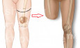 Amputation über dem Knie