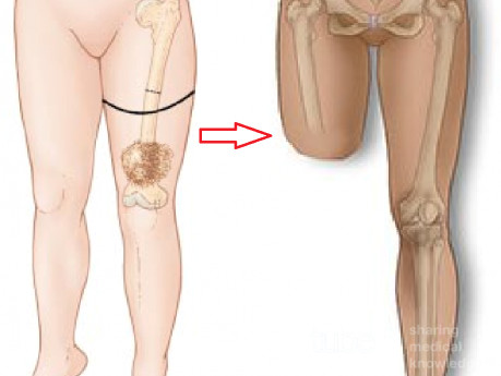 Amputation über dem Knie