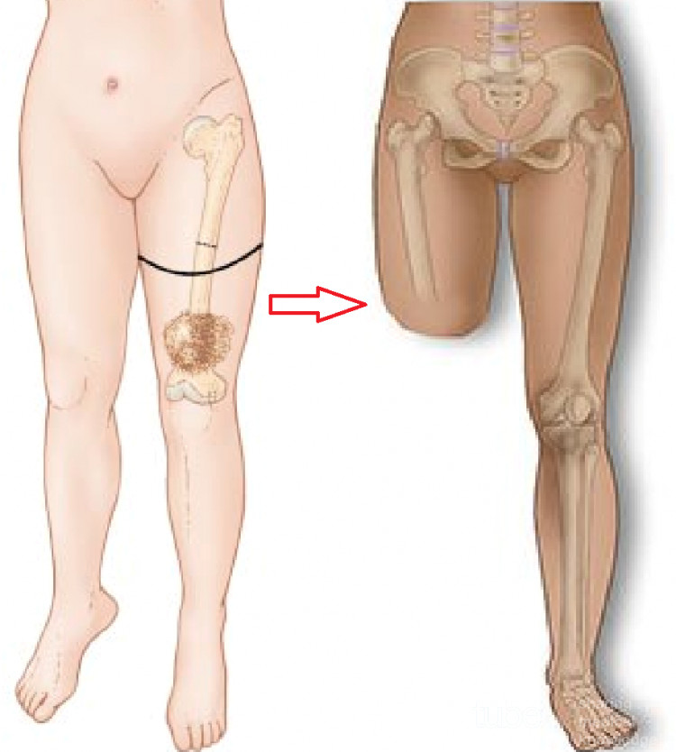 Amputation über dem Knie