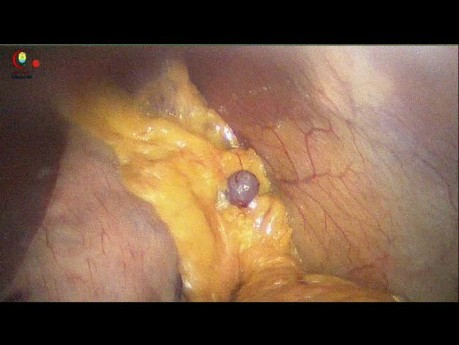 Milzzäpfchen (Splenule)