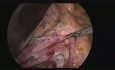 Laparoskopische Duodenojejunostomie von Arteria-mesenterica-superior-Syndrom