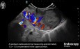 EUS-gesteuerte Ethanolaablation eines mediastinalen Nebenschilddrüsenadenoms mit Verletzung des Nervus laryngeus recurrens
