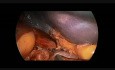 Laparoskopische Splenektomie bei Kindern - "Gefäße zuerst" Technik