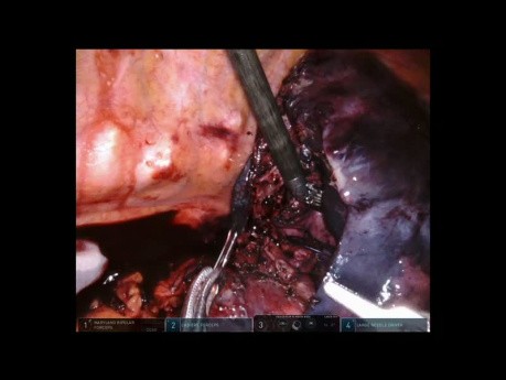 Lobektomie Unterlappen links und bronchoplastische Operation