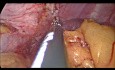 Laparoskopische Sleeve-Gastrektomie