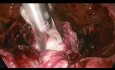 Zervikale Schwangerschaft - laparoskopisches Verfahren