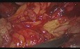 Laparoskopische distale Pankreatektomie bei ungewöhnlicher metastatischer Läsion in der Bauchspeicheldrüse