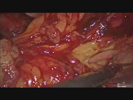 Laparoskopische distale Pankreatektomie bei ungewöhnlicher metastatischer Läsion in der Bauchspeicheldrüse