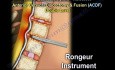 Halswirbelsäule - Dekompression und Fusion