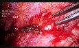 Videothorakoskopische Pleurektomie und Keilresektion eines Fragments des Oberlappens der linken Lunge.