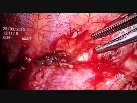 Videothorakoskopische Pleurektomie und Keilresektion eines Fragments des Oberlappens der linken Lunge.