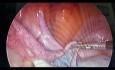 Laparoskopische Operation der Obstruktion des linken Eileiters