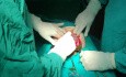 Die hypertrophierte Plazenta der Patientin nach 2 Kaiserschnitten 