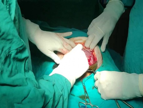 Die hypertrophierte Plazenta der Patientin nach 2 Kaiserschnitten 
