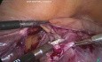Ovarialtorsion nach Hysterektomie