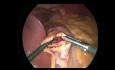 Besonderheiten der Magenbeutelbildung beim Magenausschluss mit Roux-Y-Anastomose mit drei Trokaren