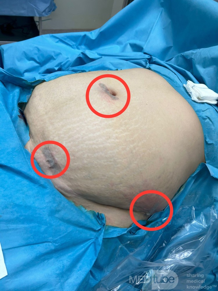 Schlauchmagen durch den Unterbauch