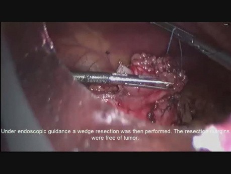 Laparoskopische und endoskopische Wedge-Resektion von Karzinoid des Magens