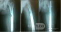 Osteoidosteom mit drohender Femurfraktur