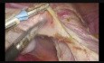 Totale laparoskopische Hysterektomie (bipolare Technik)