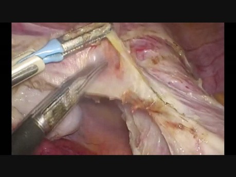 Totale laparoskopische Hysterektomie (bipolare Technik)