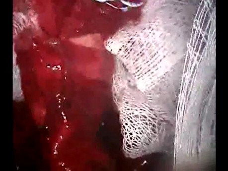 Operation der Aortendissektion – Stanford A Typ 