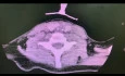 Erworbene subglottische Stenose