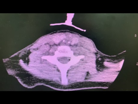 Erworbene subglottische Stenose