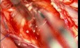 Intramedullärer Tumor des Halswirbelsäulenmarks – mikrochirurgische Exzision