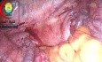 Test zur Ausschlussdiagnostik einer Verletzung des linken Kolons