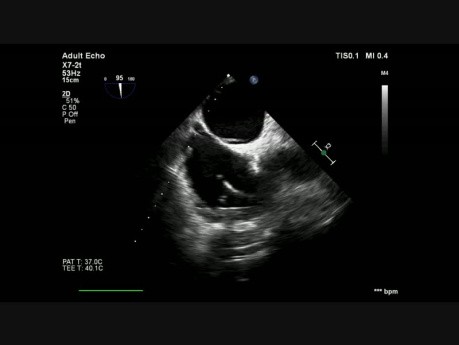Thrombus von einer Herzschrittmacherelektrode