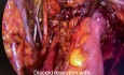 Resektion mit Hysterektomie bei tief infiltrierender Endometriose